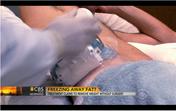 Friday ChitChat | CoolSculpting – Fat Removal without a Scalpel